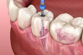 Crowns and bridges in lucknow, Best dentures in lucknow, Best maxillofacial surgeon in lucknow, Best dentist in Lucknow,  dentist in Lucknow